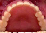 従来型の総義歯