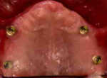 歯科インプラントと義歯の コンビネーション