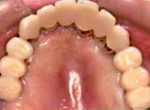 最終的な歯の完成まで約1年～2年