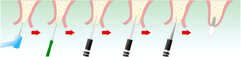 インプラント手術の特徴
