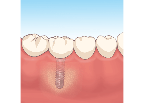 インプラント