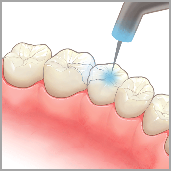 虫歯予防と治療