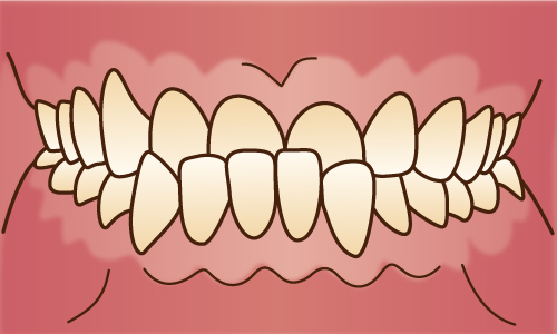 反対咬合（受け口）である