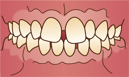 前歯がすきっ歯である