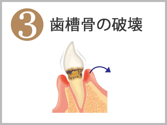 ３歯槽骨の破壊