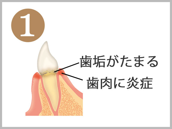 １歯垢がたまる、歯肉に炎症