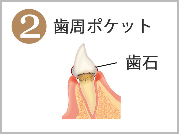 2歯周ポケット