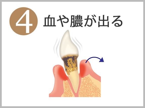 ４血や膿が出る