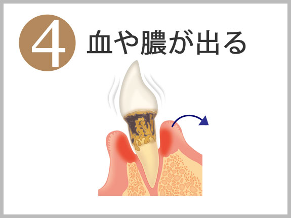 ４血や膿が出る