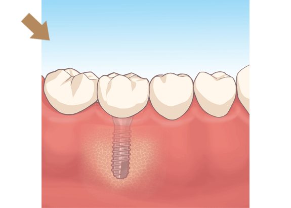 デンタルインプラントによる治療