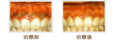 歯グキの黒ずみ　治療　