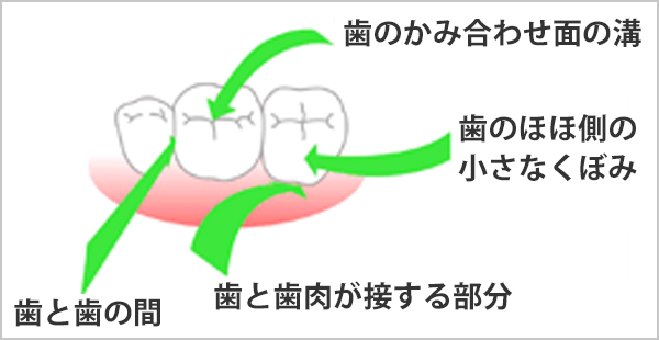 虫歯のできやすい所