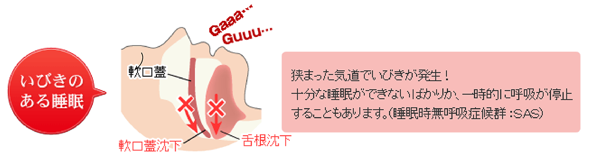 いびきのある睡眠