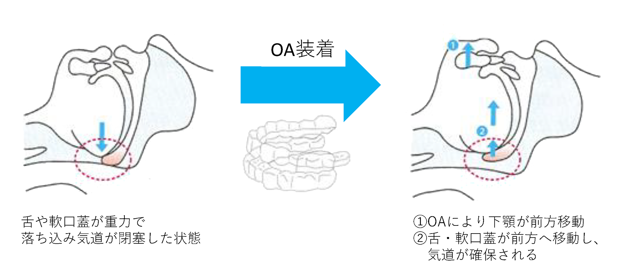 睡眠時無呼吸での装着するOA(Oral Appliance:口腔内装置 )のメカニズム