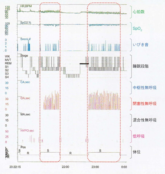 睡眠時無呼吸の診断