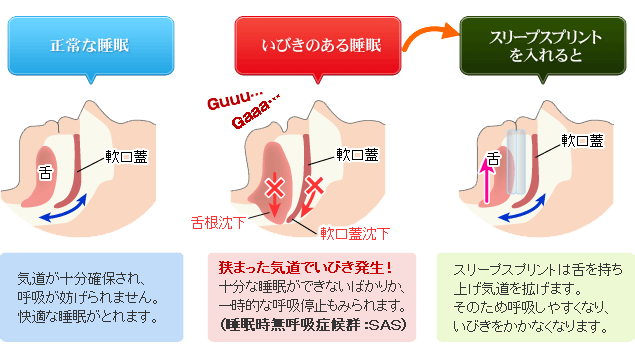 1.マウスピース